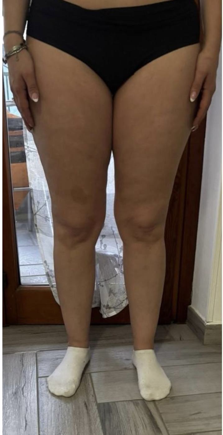 Gambe di Jacqueline dopo il percorso anti-lipedema