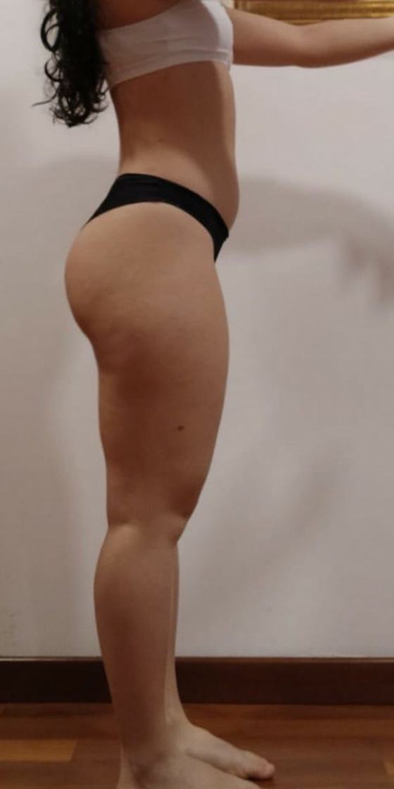 Gambe di Lara, 42 prima del percorso anti-lipedema