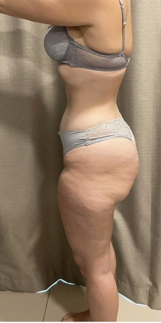 Gambe di Silvia V. prima del percorso anti-lipedema