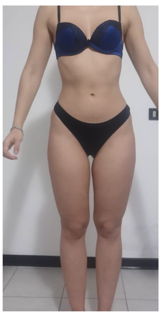 Gambe di Vivien dopo il percorso anti-lipedema