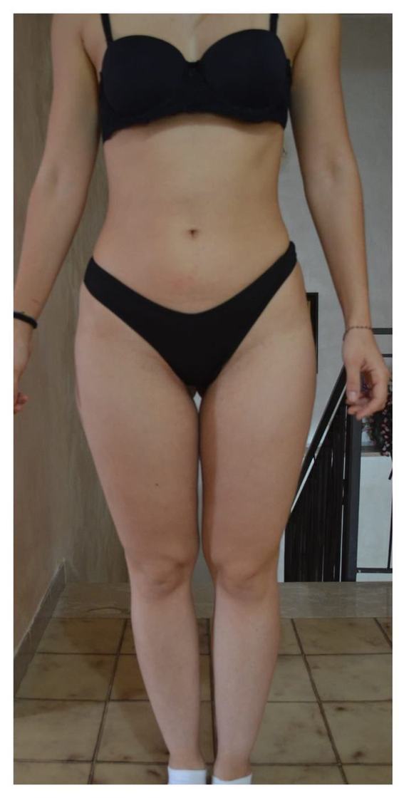 Gambe di Vivien prima del percorso anti-lipedema